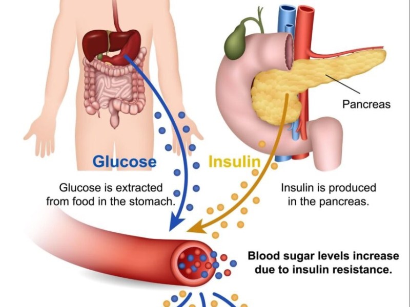 For decades, type 2 diabetes was framed as a complex multifactorial disease with heterogeneous causes. Then a British researcher actually scanned the organs. The mechanism turned out to be simple — and the implications change&nbsp;everything.